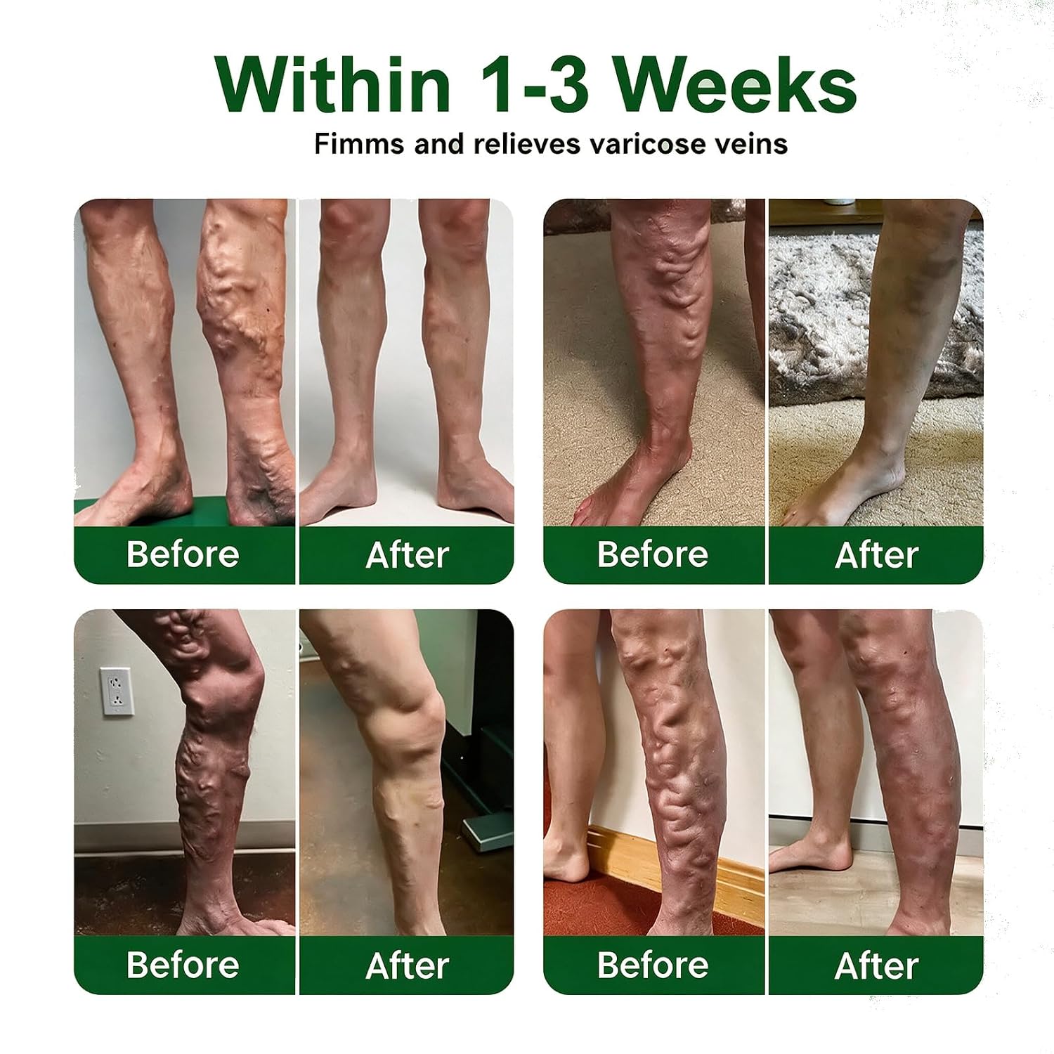 Sorviq Miracle Balm for Varicose Veins - Improves Blood Circulation, Professional Varicose Veins Treatment Cream for Feet and Body, Moisturizing & Soothing, Natural Serum for All Skin Types