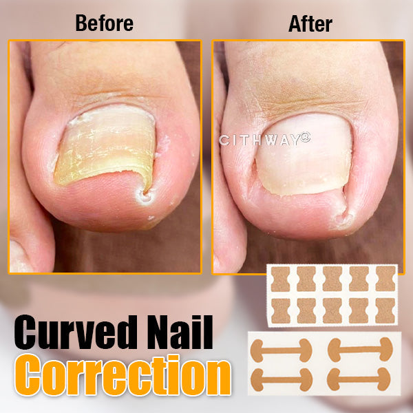 Cithway® Ingrown Toenail Corrector Kit