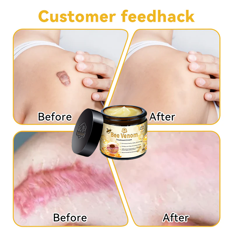 Official Store: TLOPA® Bee Venom Skin Treatment Cream👨‍⚕️British Association of Dermatologists (BAD) Approved⛄🎉