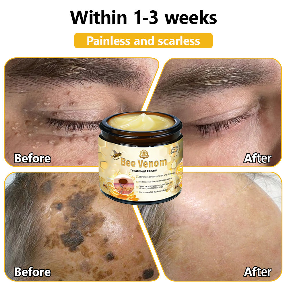 𝗧𝗟𝗢𝗣𝗔® Bee Venom Skin Treatment Cream – AAD Recommended👨‍⚕️(🔥LAST DAY 70% OFF)🔥