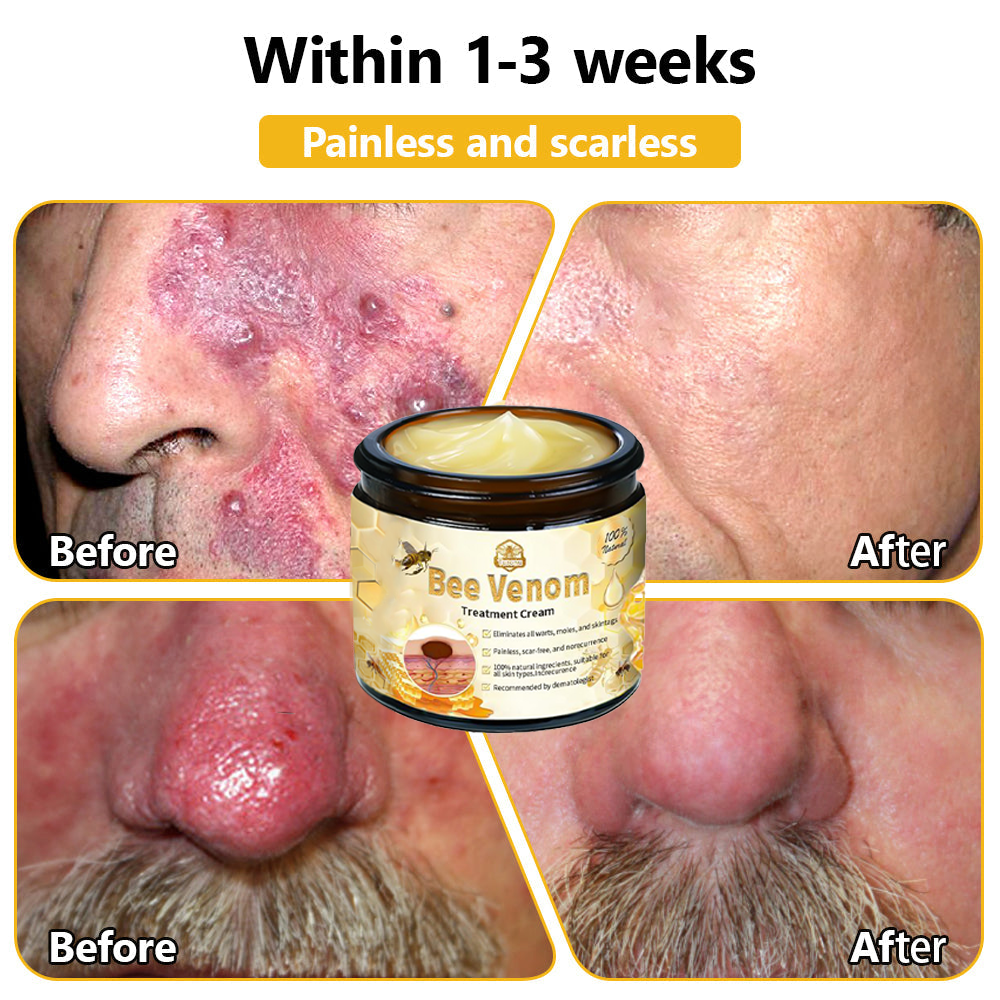 𝗧𝗟𝗢𝗣𝗔® Bee Venom Skin Treatment Cream – AAD Recommended👨‍⚕️(🔥LAST DAY 70% OFF)🔥