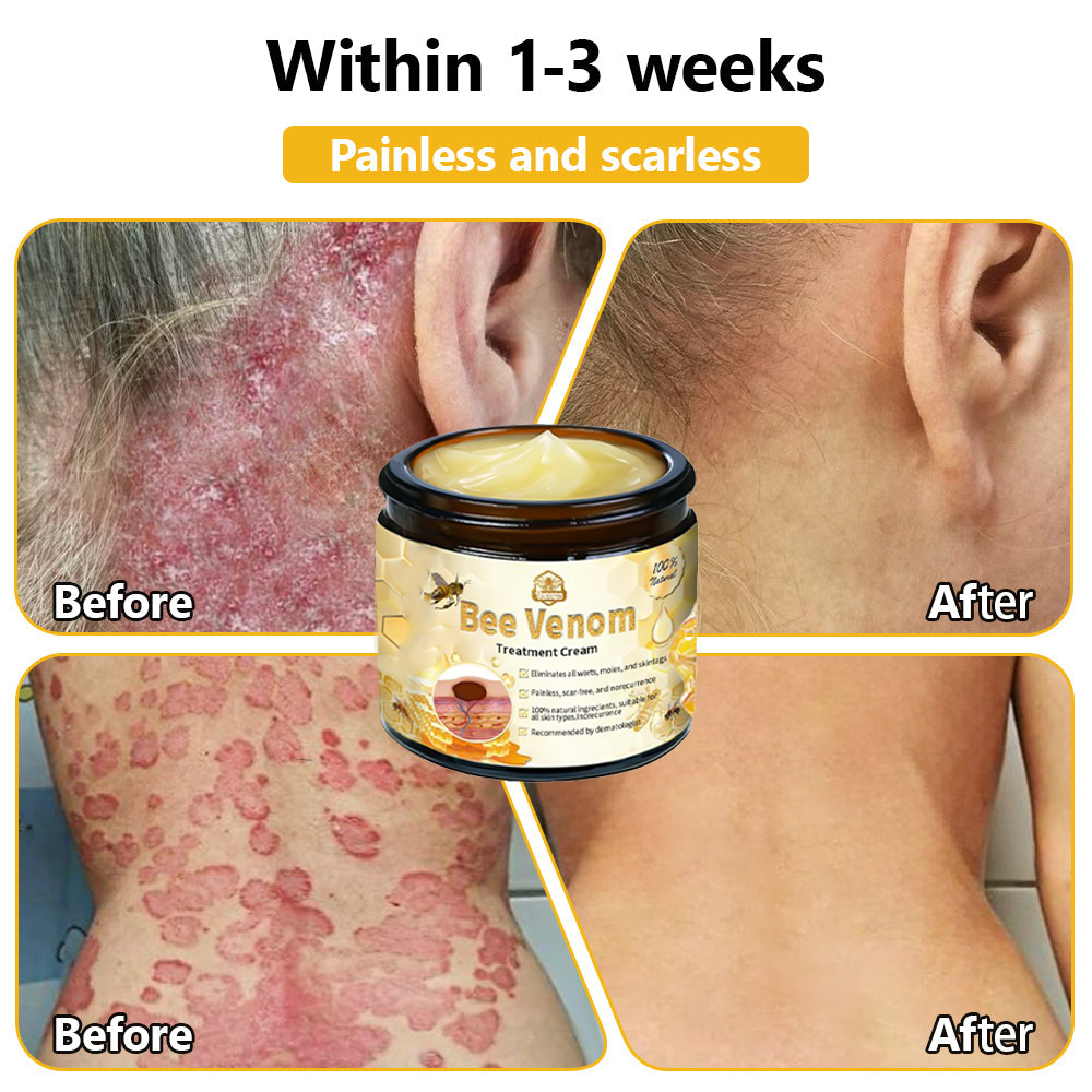 𝗧𝗟𝗢𝗣𝗔® Bee Venom Skin Treatment Cream – AAD Recommended👨‍⚕️(🔥LAST DAY 70% OFF)🔥