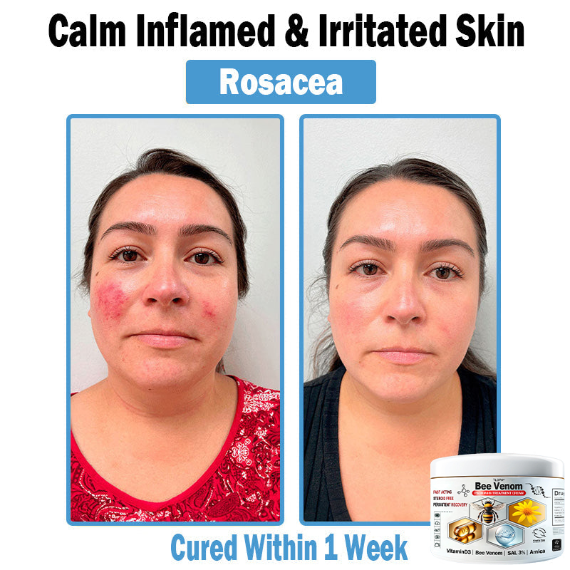 𝙏𝙇𝙊𝙋𝘼®𝑩𝒆𝒆 𝑽𝒆𝒏𝒐𝒎 𝑴𝒖𝒍𝒕𝒊-𝑺𝒚𝒎𝒑𝒕𝒐𝒎 𝑺𝒌𝒊𝒏 𝑻𝒓𝒆𝒂𝒕𝒎𝒆𝒏𝒕 𝑪𝒓𝒆𝒂𝒎 (👨‍⚕𝑵𝑷𝑭 𝑹𝑬𝑪𝑶𝑴𝑴𝑬𝑵𝑫𝑺)👨‍⚕