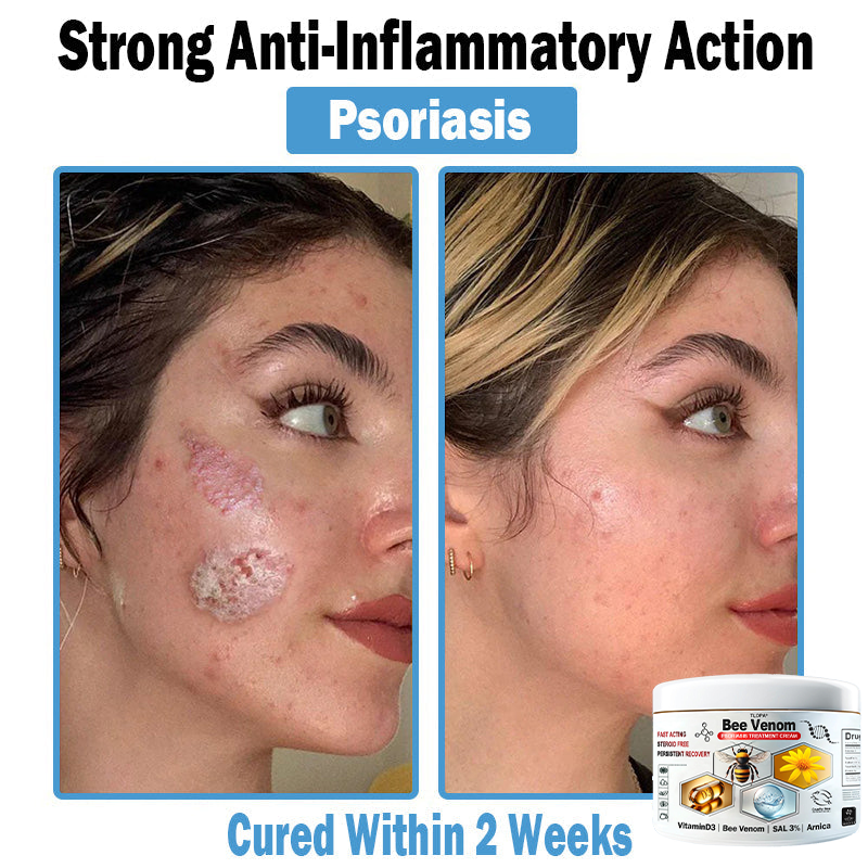 𝙏𝙇𝙊𝙋𝘼®𝑩𝒆𝒆 𝑽𝒆𝒏𝒐𝒎 𝑴𝒖𝒍𝒕𝒊-𝑺𝒚𝒎𝒑𝒕𝒐𝒎 𝑺𝒌𝒊𝒏 𝑻𝒓𝒆𝒂𝒕𝒎𝒆𝒏𝒕 𝑪𝒓𝒆𝒂𝒎 (👨‍⚕𝑵𝑷𝑭 𝑹𝑬𝑪𝑶𝑴𝑴𝑬𝑵𝑫𝑺)👨‍⚕