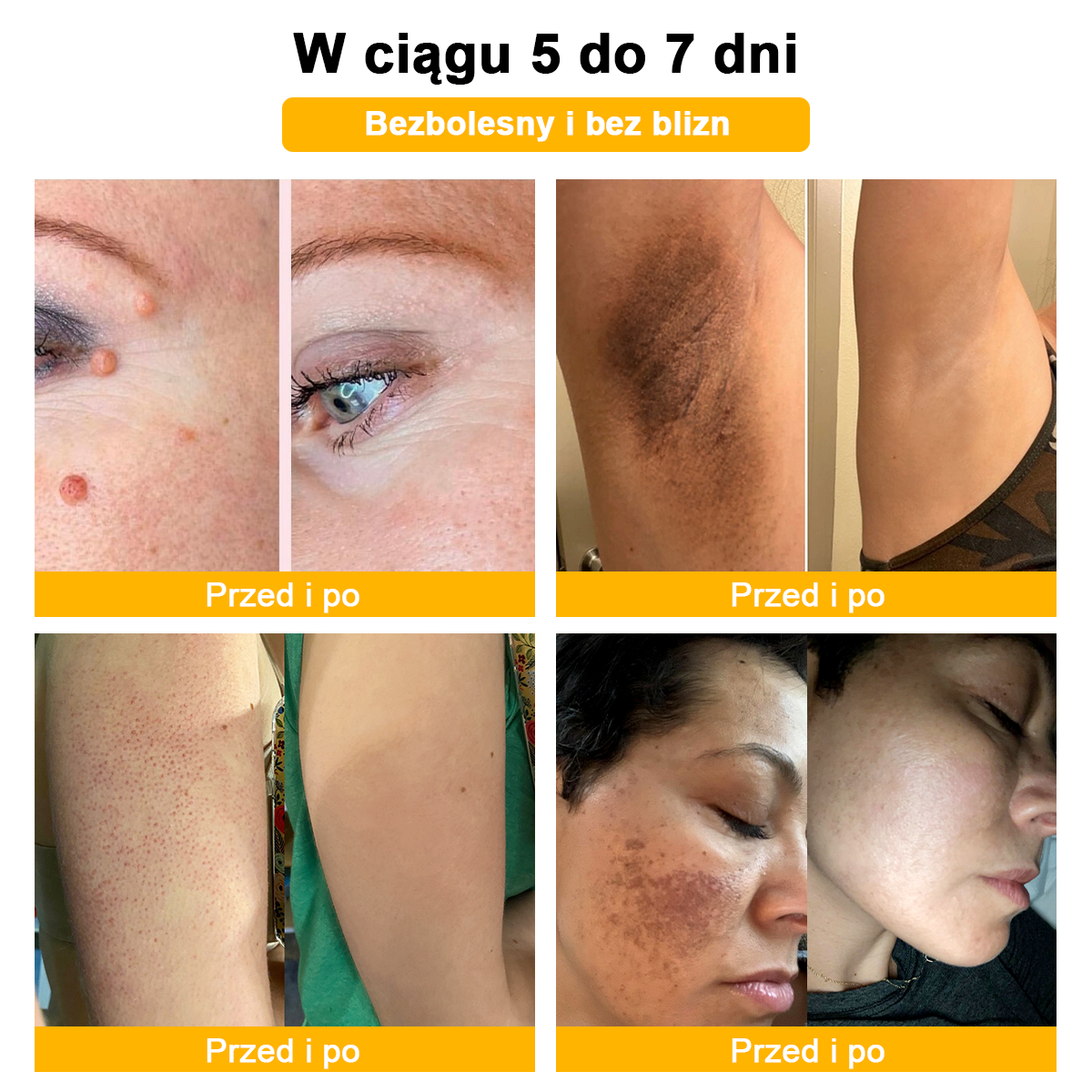 👨‍⚕️👨‍⚕️[✨Oficjalny sklep marki✨] Krem na pieprzyki i brodawki Zoencgz™ z jadem pszczelim (👨‍⚕AAD POLECA)