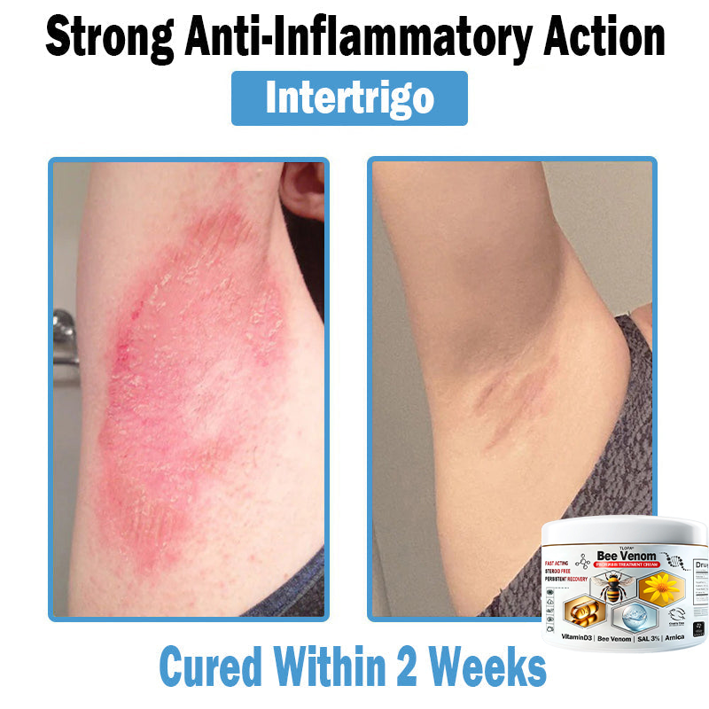 𝙏𝙇𝙊𝙋𝘼®𝑩𝒆𝒆 𝑽𝒆𝒏𝒐𝒎 𝑴𝒖𝒍𝒕𝒊-𝑺𝒚𝒎𝒑𝒕𝒐𝒎 𝑺𝒌𝒊𝒏 𝑻𝒓𝒆𝒂𝒕𝒎𝒆𝒏𝒕 𝑪𝒓𝒆𝒂𝒎 (👨‍⚕𝑵𝑷𝑭 𝑹𝑬𝑪𝑶𝑴𝑴𝑬𝑵𝑫𝑺)👨‍⚕