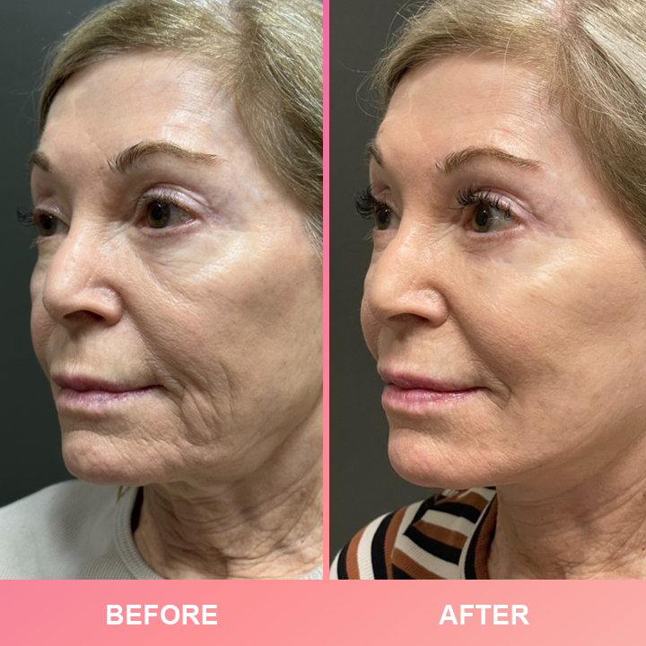 LIMETOW™ Compact Anti-Wrinkle Bar