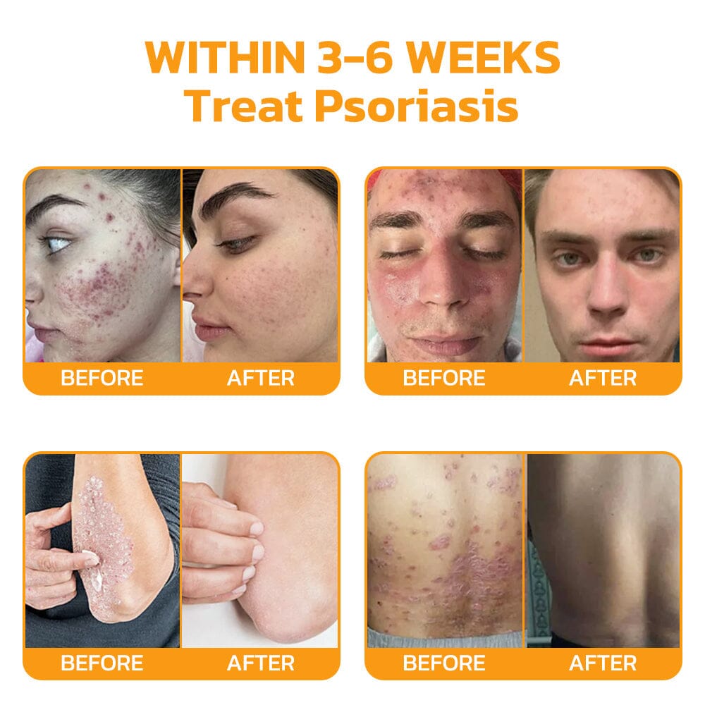 Therapeutic Goods Administration (TGA)✅ Furzero™ Bee Venom Skincare Treatment Pads (⚕️AAD Recommended)