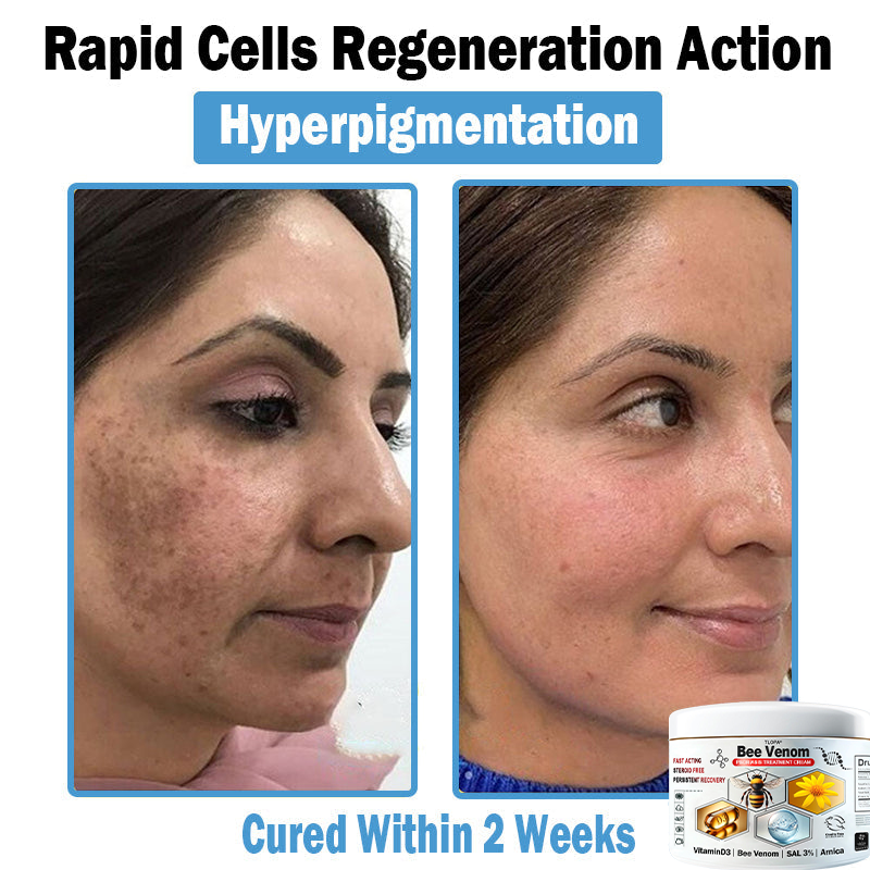 𝙏𝙇𝙊𝙋𝘼®𝑩𝒆𝒆 𝑽𝒆𝒏𝒐𝒎 𝑴𝒖𝒍𝒕𝒊-𝑺𝒚𝒎𝒑𝒕𝒐𝒎 𝑺𝒌𝒊𝒏 𝑻𝒓𝒆𝒂𝒕𝒎𝒆𝒏𝒕 𝑪𝒓𝒆𝒂𝒎 (👨‍⚕𝑵𝑷𝑭 𝑹𝑬𝑪𝑶𝑴𝑴𝑬𝑵𝑫𝑺)👨‍⚕