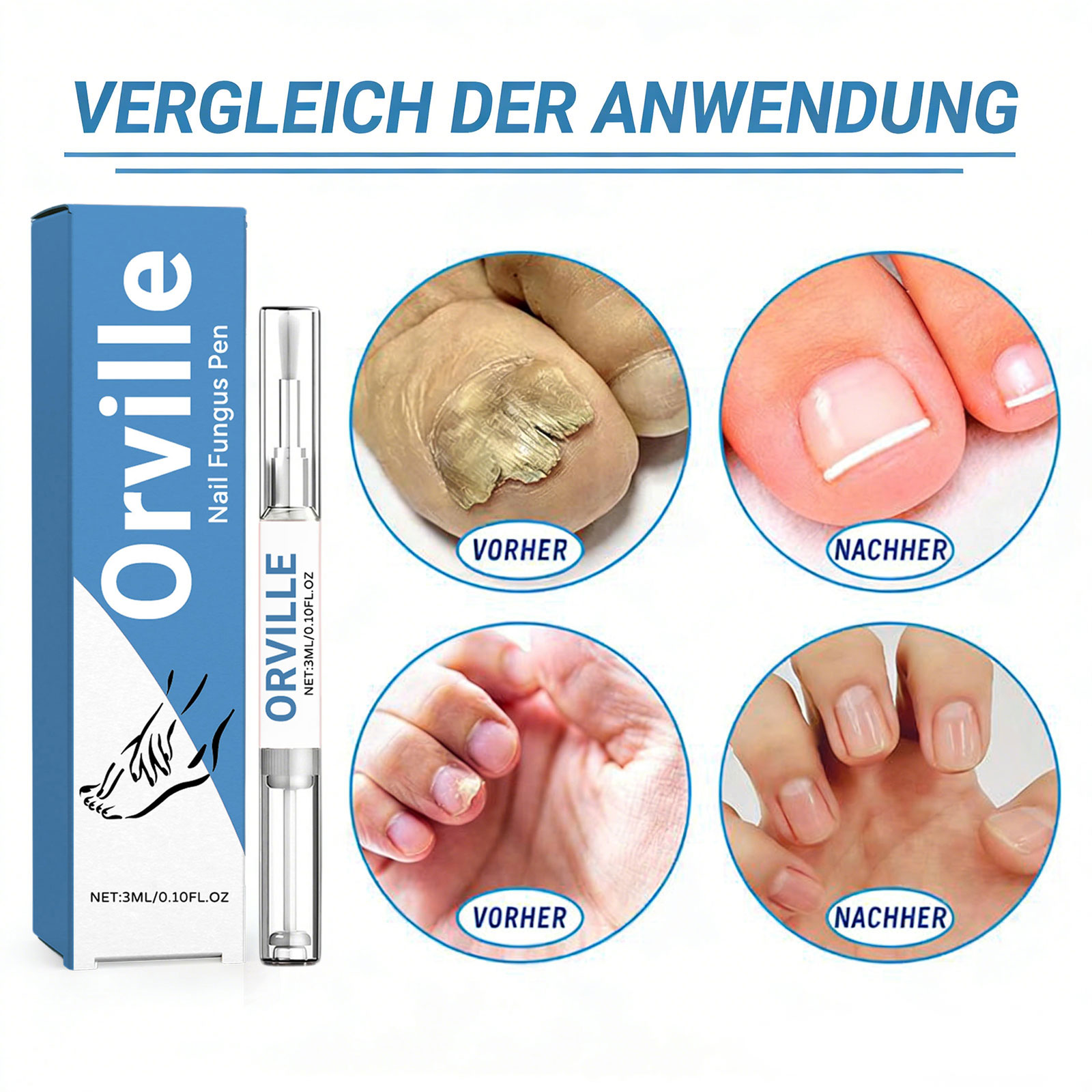 Orville Nagelpilz Stift Original, Natürliches Inhaltsstoffserum für Stärkungsnägel, 2026 Neu Nail Care Pen Nagelpilz für Jeden Geeignet