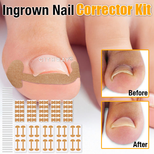 Cithway® Ingrown Toenail Corrector Kit