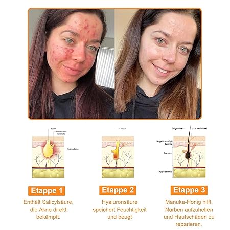 Bienengift Hautregenerationscreme, Professionelle Bienengift Creme, Ourlyard Bee Venom Hautregenerierende Creme, Bienengiftsalbe, Bienengiftcreme für alle Hauttypen