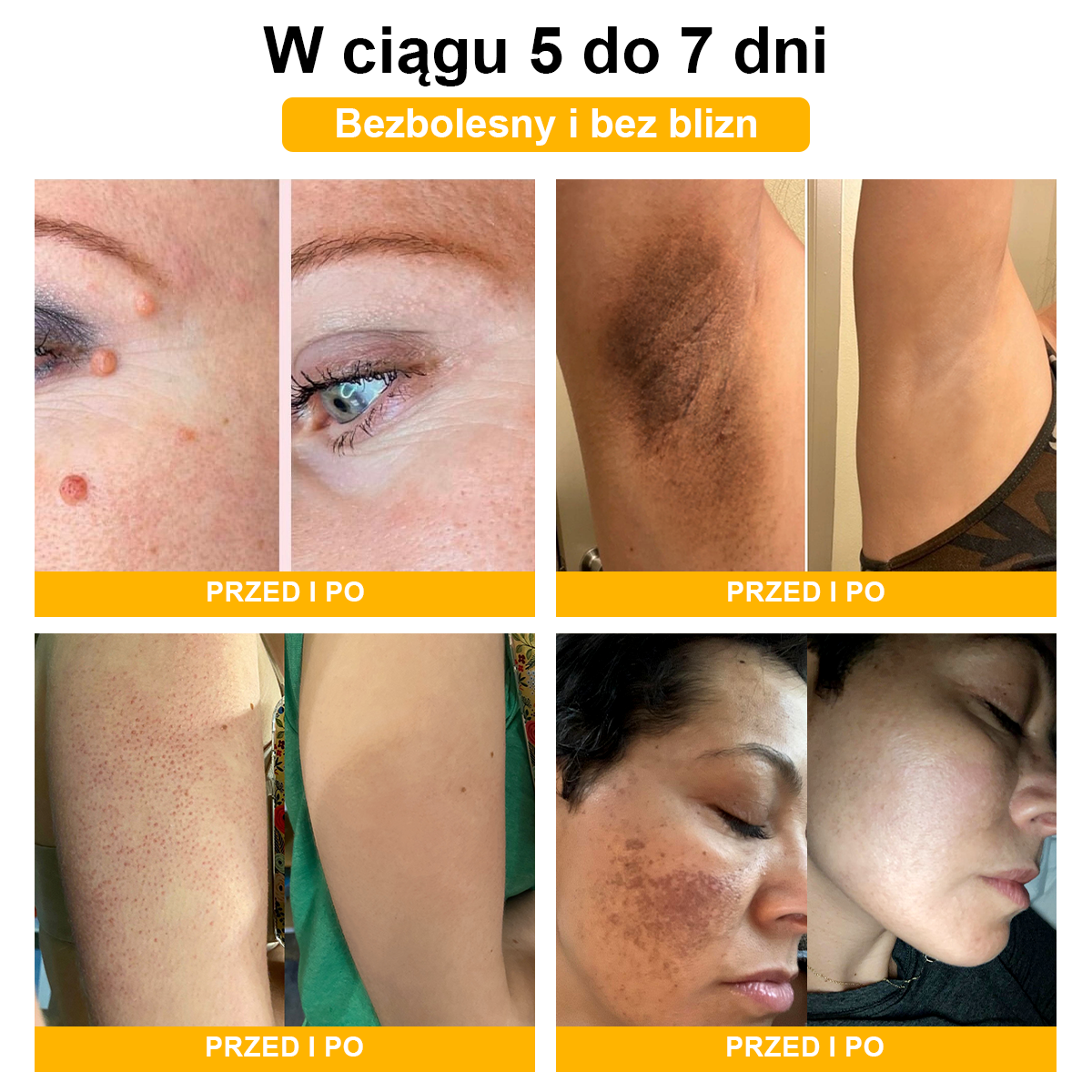 [🌟 Za pobraniem 🌟] 𝐀𝐰𝐳𝐥𝐨𝐯𝐞™ Krem leczący znamiona i brodawki z jadem pszczelim (👨‍⚕Zalecenia AAD )