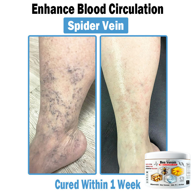 𝙏𝙇𝙊𝙋𝘼®𝑩𝒆𝒆 𝑽𝒆𝒏𝒐𝒎 𝑴𝒖𝒍𝒕𝒊-𝑺𝒚𝒎𝒑𝒕𝒐𝒎 𝑺𝒌𝒊𝒏 𝑻𝒓𝒆𝒂𝒕𝒎𝒆𝒏𝒕 𝑪𝒓𝒆𝒂𝒎 (👨‍⚕𝑵𝑷𝑭 𝑹𝑬𝑪𝑶𝑴𝑴𝑬𝑵𝑫𝑺)👨‍⚕