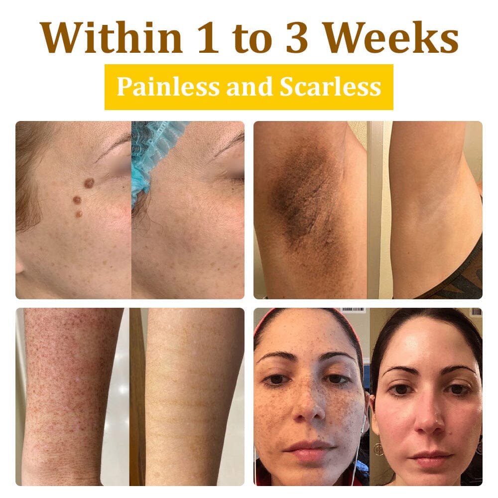 🏆✅flysmus™ Bee Venom Treatment Cream🐝: Helps with Eczema, Psoriasis, Acne, Rosacea, Fungal Infections, and Warts