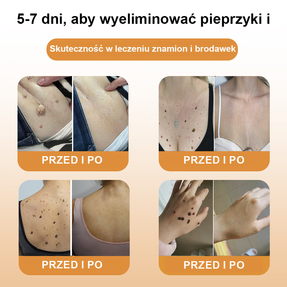 [🌟 Za pobraniem 🌟] 𝐀𝐰𝐳𝐥𝐨𝐯𝐞™ Krem leczący znamiona i brodawki z jadem pszczelim (👨‍⚕Zalecenia AAD )