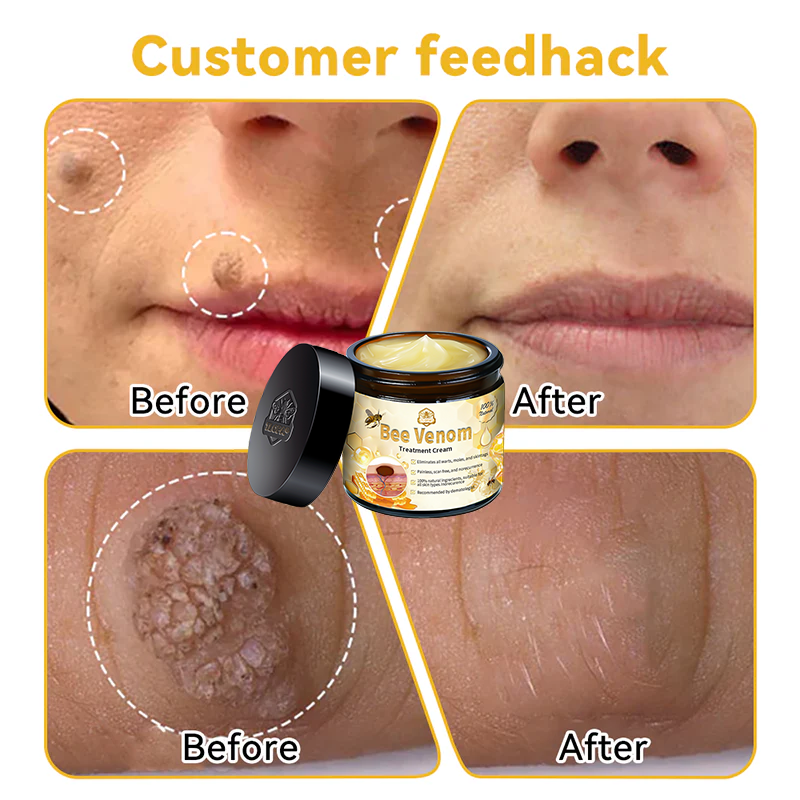 Official Store: TLOPA® Bee Venom Skin Treatment Cream👨‍⚕️British Association of Dermatologists (BAD) Approved⛄🎉