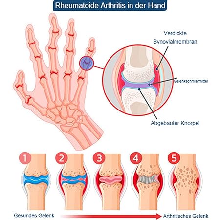 Bienengift-Schmerzlinderungs Knochenheilungs Creme, Professionelle Bienengift Gelenkcreme, Ourlyard Bienengift Gelenkgel, Natürlich Bienengiftsalbe Joint Gel, für Rücken,Nacken,Knie
