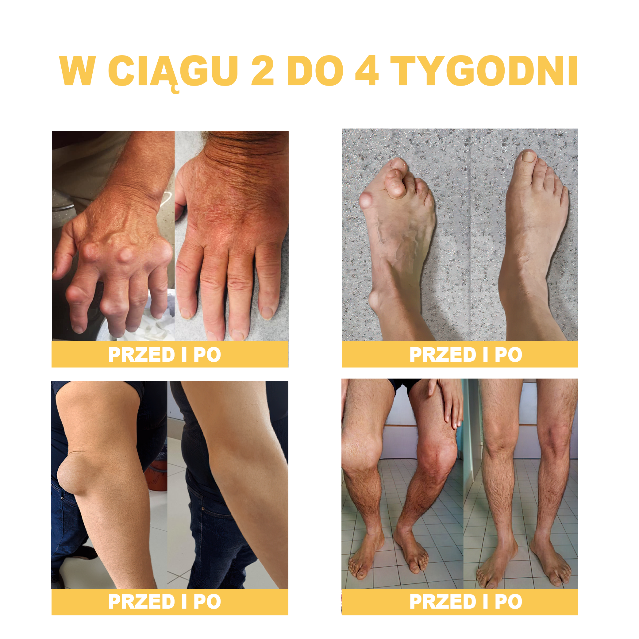 🏆🌈[✨Oficjalny sklep flagowy✨]Zoencgz™ Krem na zapalenie stawów i żylaki z jadem pszczelim