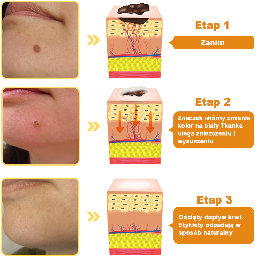 👨‍⚕️👨‍⚕️[✨Oficjalny sklep marki✨] Krem na pieprzyki i brodawki Zoencgz™ z jadem pszczelim (👨‍⚕AAD POLECA)