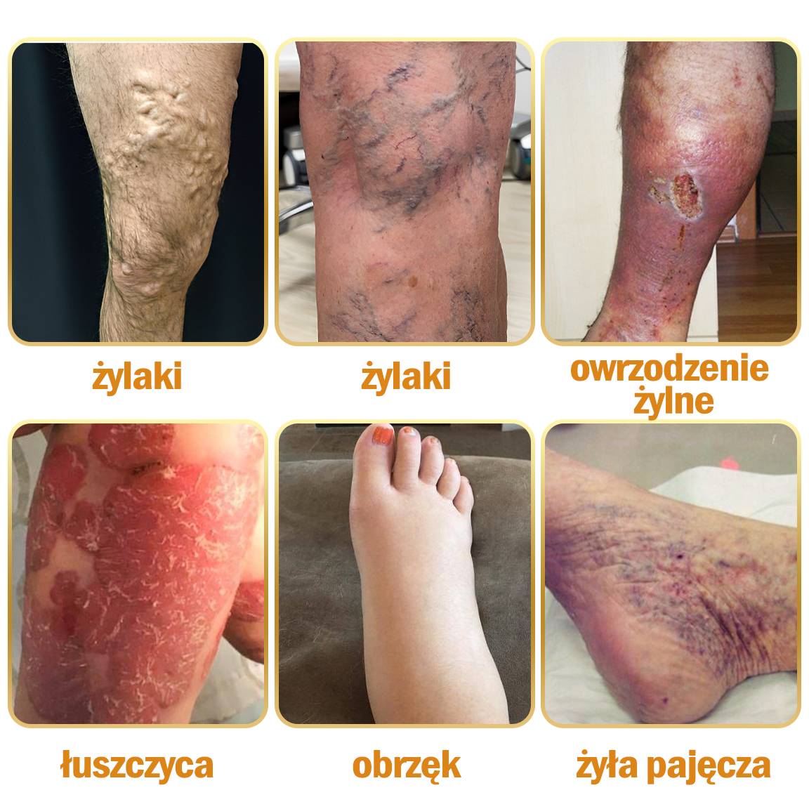 🏆🌈[✨Oficjalny sklep flagowy✨]Zoencgz™ Krem na zapalenie stawów i żylaki z jadem pszczelim