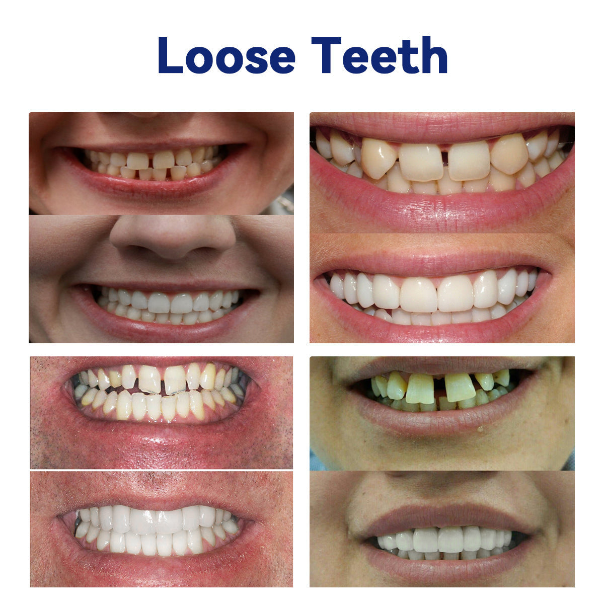 𝐵𝑖𝑘𝑒𝑛𝑑𝑎™ 𝑆𝑖𝑙𝑖𝑐𝑜𝑛𝑒 𝐷𝑒𝑛𝑡𝑢𝑟𝑒 𝑅𝑢𝑙𝑒𝑟 𝑆𝑒𝑡 (👩‍🔬ADA 𝐶𝑜𝑚𝑝𝑙𝑖𝑎𝑛𝑡 𝐴𝑝𝑝𝑟𝑜𝑣𝑒𝑑 𝐵𝑦 𝑃𝑟𝑜𝑓𝑒𝑠𝑠𝑖𝑜𝑛𝑎𝑙 𝐷𝑒𝑛𝑡𝑖𝑠𝑡𝑠)