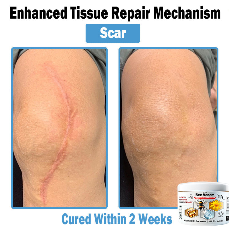 𝙏𝙇𝙊𝙋𝘼®𝑩𝒆𝒆 𝑽𝒆𝒏𝒐𝒎 𝑴𝒖𝒍𝒕𝒊-𝑺𝒚𝒎𝒑𝒕𝒐𝒎 𝑺𝒌𝒊𝒏 𝑻𝒓𝒆𝒂𝒕𝒎𝒆𝒏𝒕 𝑪𝒓𝒆𝒂𝒎 (👨‍⚕𝑵𝑷𝑭 𝑹𝑬𝑪𝑶𝑴𝑴𝑬𝑵𝑫𝑺)👨‍⚕