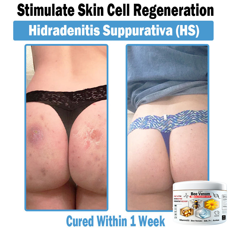 𝙏𝙇𝙊𝙋𝘼®𝑩𝒆𝒆 𝑽𝒆𝒏𝒐𝒎 𝑴𝒖𝒍𝒕𝒊-𝑺𝒚𝒎𝒑𝒕𝒐𝒎 𝑺𝒌𝒊𝒏 𝑻𝒓𝒆𝒂𝒕𝒎𝒆𝒏𝒕 𝑪𝒓𝒆𝒂𝒎 (👨‍⚕𝑵𝑷𝑭 𝑹𝑬𝑪𝑶𝑴𝑴𝑬𝑵𝑫𝑺)👨‍⚕