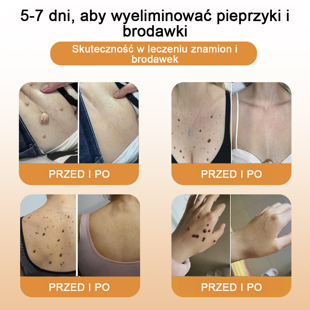 👨‍⚕️👨‍⚕️[✨Oficjalny sklep marki✨] Krem na pieprzyki i brodawki Zoencgz™ z jadem pszczelim (👨‍⚕AAD POLECA)