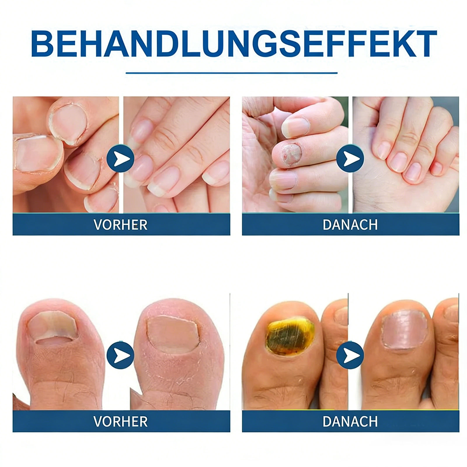 Orville Nagelpilz Stift Original, Natürliches Inhaltsstoffserum für Stärkungsnägel, 2026 Neu Nail Care Pen Nagelpilz für Jeden Geeignet