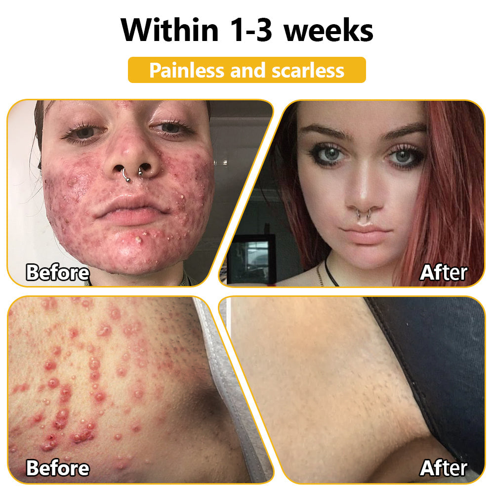 𝗧𝗟𝗢𝗣𝗔® Bee Venom Skin Treatment Cream – AAD Recommended👨‍⚕️(🔥LAST DAY 70% OFF)🔥
