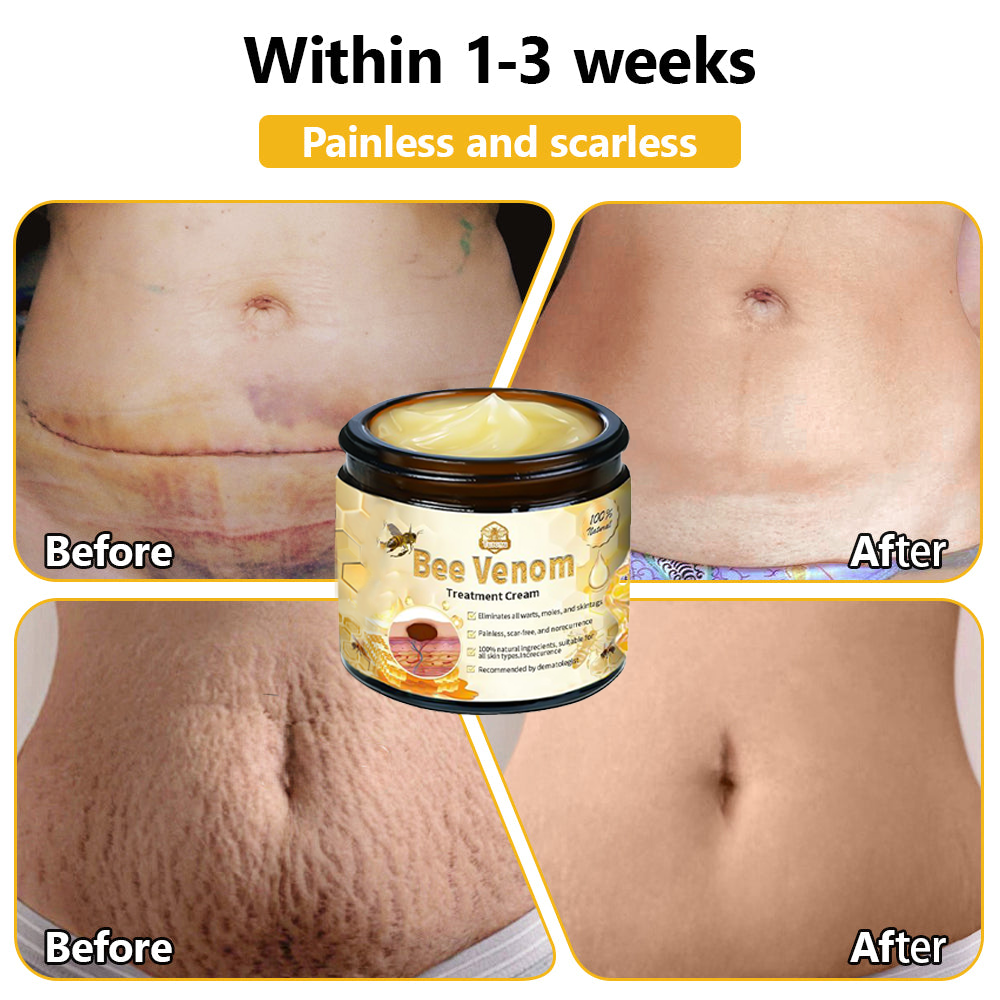 𝗧𝗟𝗢𝗣𝗔® Bee Venom Skin Treatment Cream – AAD Recommended👨‍⚕️(🔥LAST DAY 70% OFF)🔥