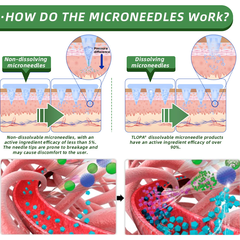 [See results in 7 days]💐𝗧𝗟𝗢𝗣𝗔® SMGT-GLP-1 Nano Microneedle Patch (Painless, long-lasting, addressing diabetes, obesity, and cardiovascular diseases)💐
