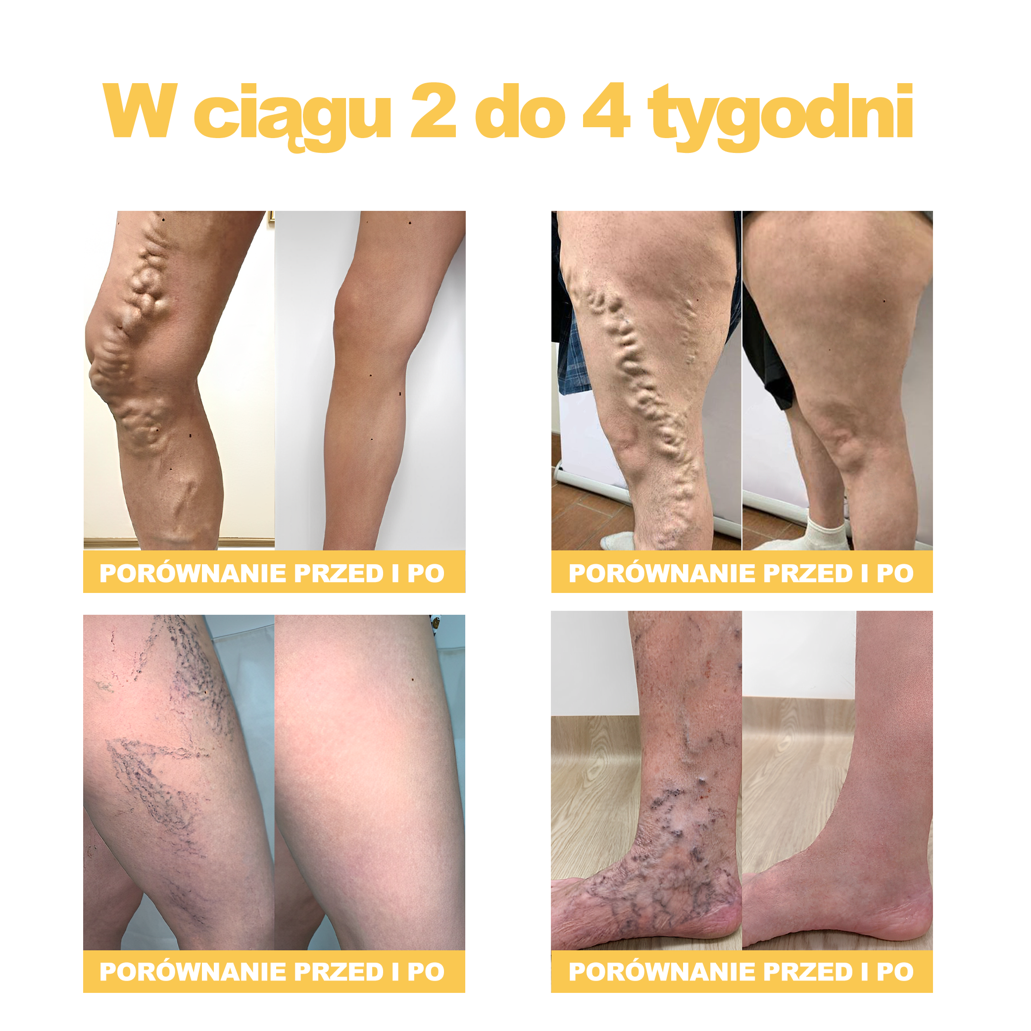 🏆🌈[✨Oficjalny sklep flagowy✨]Zoencgz™ Krem na zapalenie stawów i żylaki z jadem pszczelim