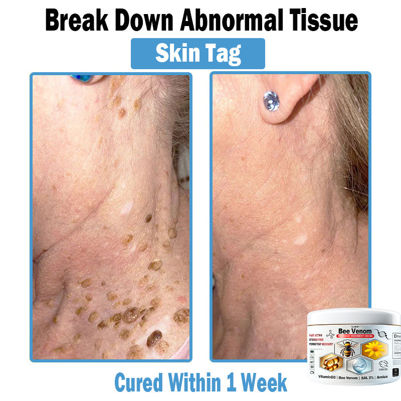 𝙏𝙇𝙊𝙋𝘼®𝑩𝒆𝒆 𝑽𝒆𝒏𝒐𝒎 𝑴𝒖𝒍𝒕𝒊-𝑺𝒚𝒎𝒑𝒕𝒐𝒎 𝑺𝒌𝒊𝒏 𝑻𝒓𝒆𝒂𝒕𝒎𝒆𝒏𝒕 𝑪𝒓𝒆𝒂𝒎 (👨‍⚕𝑵𝑷𝑭 𝑹𝑬𝑪𝑶𝑴𝑴𝑬𝑵𝑫𝑺)👨‍⚕