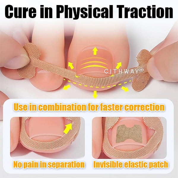 Cithway® Ingrown Toenail Corrector Kit