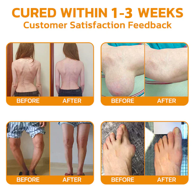 Official Store: TLOPA® Bee-Venom Pain-Relief Bone Healing Cream👨‍⚕️USA Osteopathic Medical Association (AAOS) Approved(Reducing joint swelling, pain, stiffness, redness, warmth, soreness, and joint fatigue)