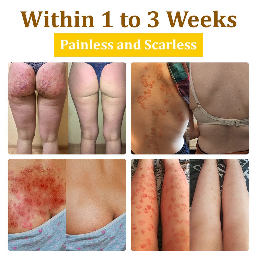 🏆✅flysmus™ Bee Venom Treatment Cream🐝: Helps with Eczema, Psoriasis, Acne, Rosacea, Fungal Infections, and Warts